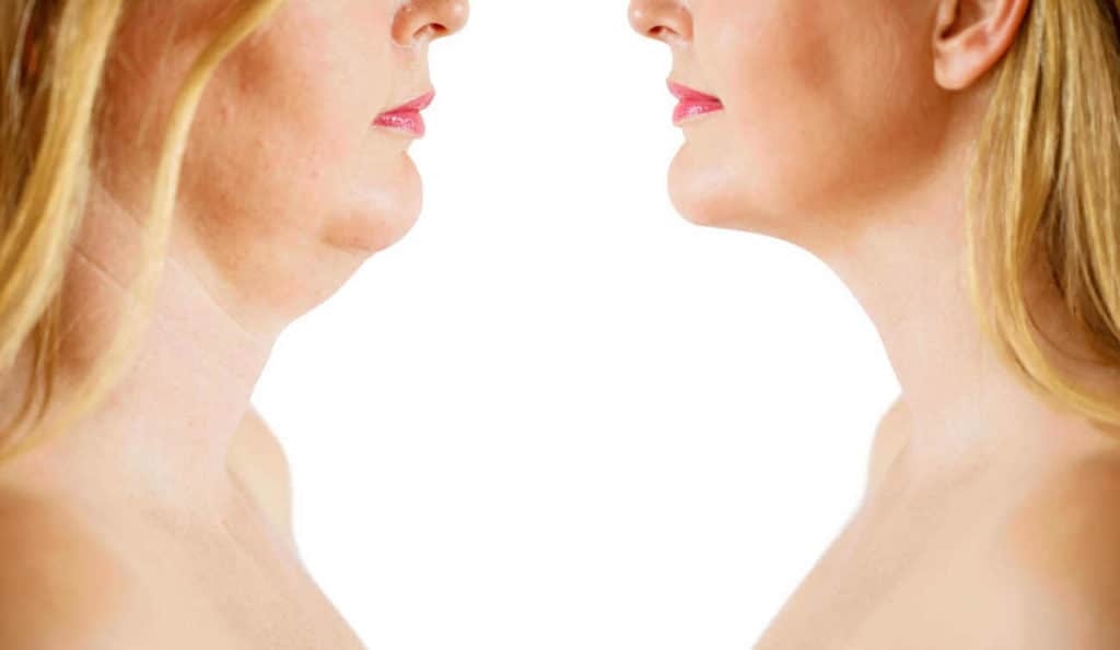 Double Chin treatment Smethwick before and after results