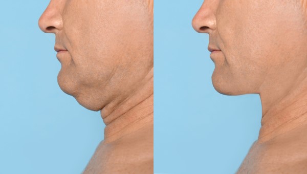 Which Non-Surgical Treatments Work Best for Jowls and Loose Skin Smethwick?