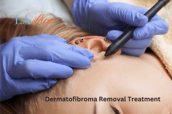 Dermatofibroma Removal Treatment Smethwick
