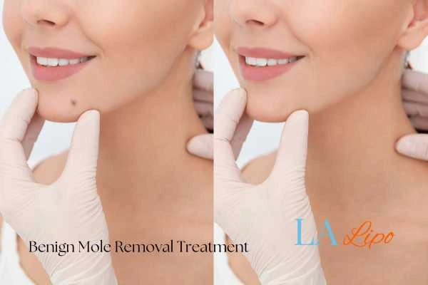 woman's before and after mole removal Smethwick results