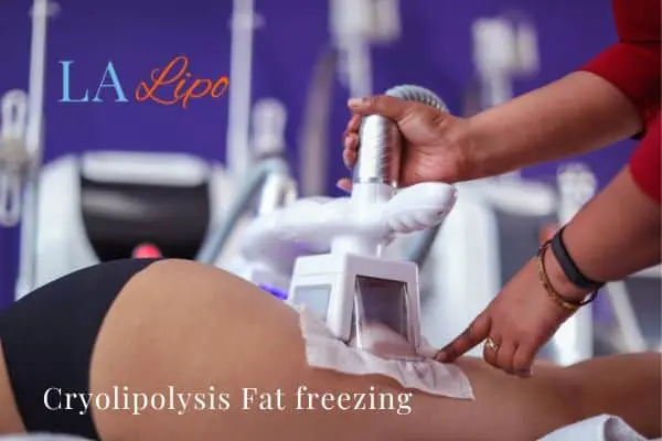 women getting fat freezing Smethwick