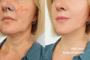 hi-fu for wrinkles Smethwick before and after results