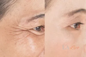 Before and after results of woman - HI-fu wrinkles reduction treatment Smethwick