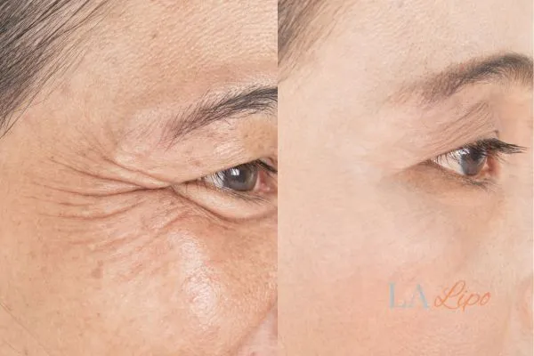 Before and after results of woman - HI-fu wrinkles reduction treatment Smethwick