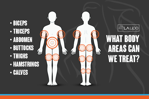 Graphic to show areas you can have LA-EMS Body Sculpting Smethwick treatment.