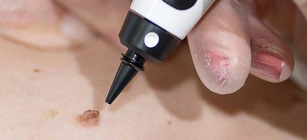 skin tag removal using cryopen Smethwick