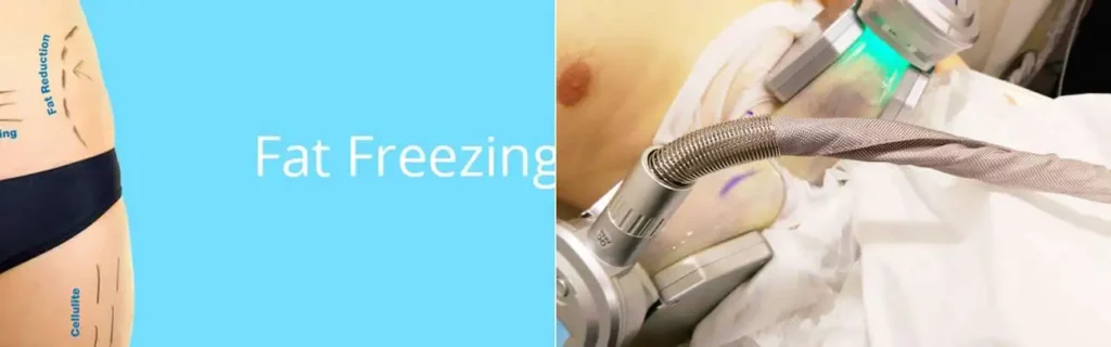 Fat freezing Smethwick on multiple areas of the body