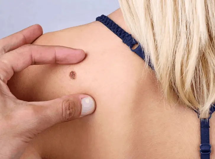 woman having mole removal Smethwick consultation before treatment.