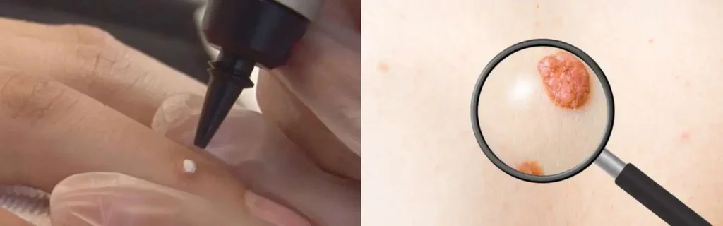 Cryopen for mole removal Smethwick - speak to our team today!