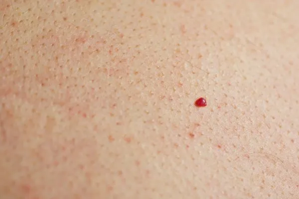 close up of a cherry angioma Smethwick