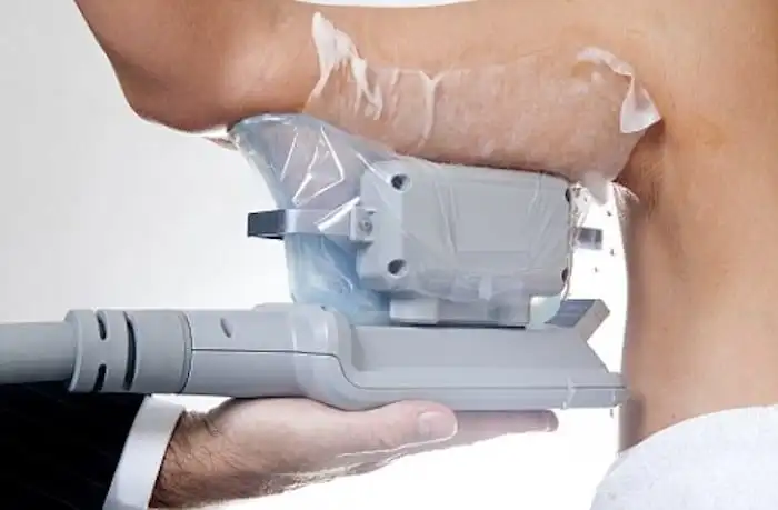 Picture of fat freezing Smethwick on the upper arms.