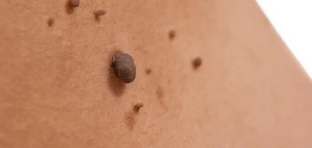 image of a skin tag Smethwick