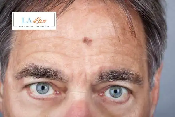 Solar Lentigo Removal Smethwick image of man with mark on his forehead
