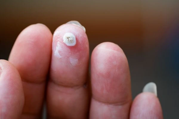 wart on person finger - cryotherapy to treat from LA LIPO Smethwick