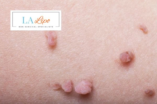 Does cryopen skin tag removal Smethwick hurt? Find out now call our team today!