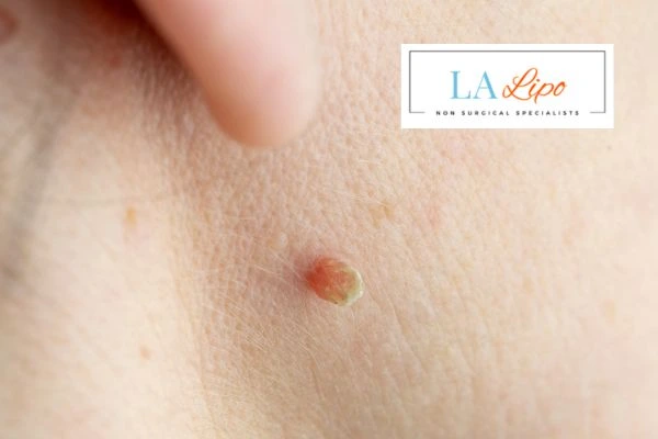 Book skin tag removal Smethwick today speak to our team now!