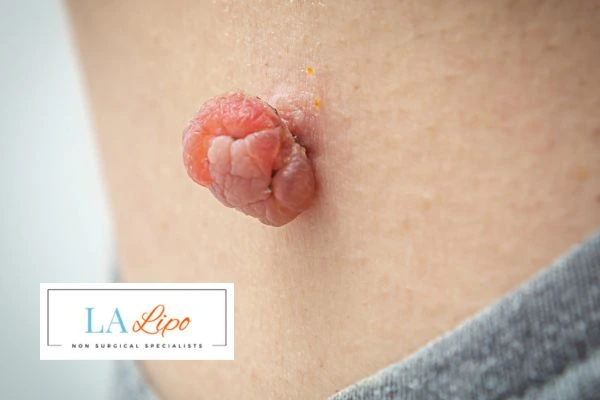 Interested in skin tag removal Smethwick? Concerned about the pain? Find out more today!