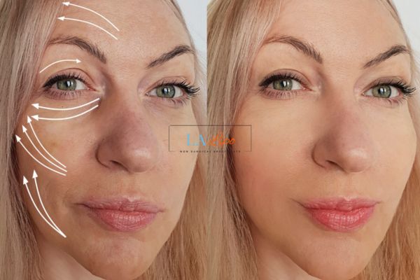 Morpheus 8 results Smethwick face lift.