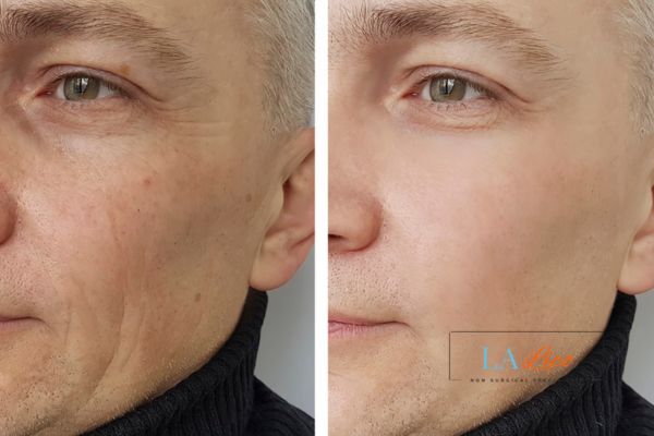 See the amazing results of Morpheus8 Treatment Smethwick!