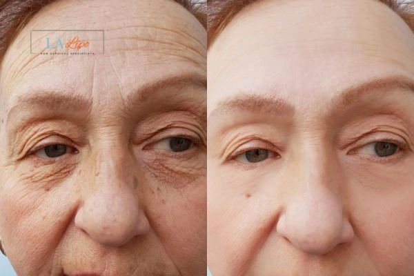 The powerful benefits of Morpheus8 Treatment Smethwick - Call Our team today!