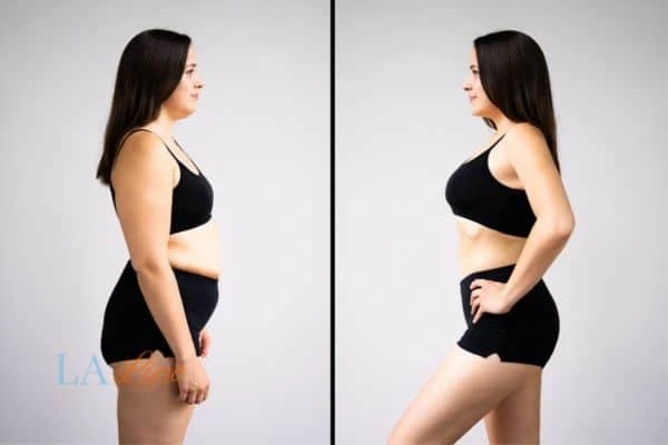 Picture of womans before and after using LA-EMS body sculpting to improve her core strength Smethwick