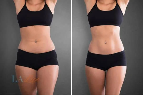 before and after results of non-surgical treatment to help a woman's body image and mental health Smethwick
