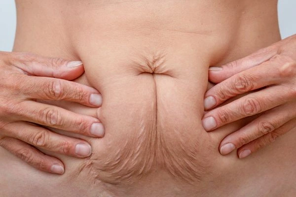Image of a woman's stomach with loose skin - example of skin tightening Smethwick options