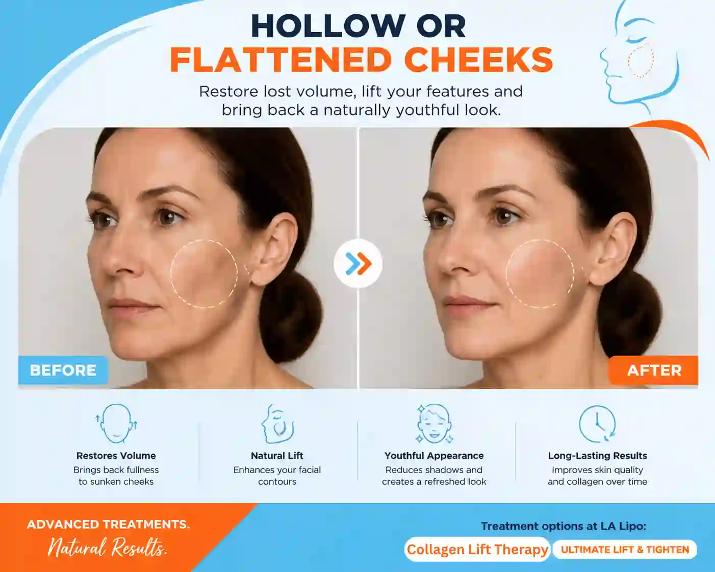 Sign #4: Hollow or Flattened Cheeks Smethwick