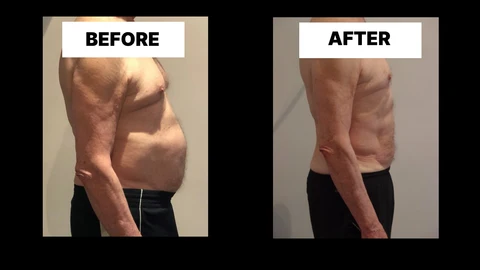 What Symptoms Can Diastasis Recti Cause in Men? Weak Core, Back Pain and Poor Posture Smethwick